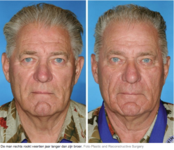 tweeling-roken-mannen-huidveroudering